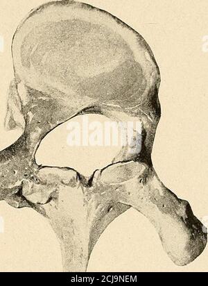 . über sprünglich ungefähr die Formeines gleichschenkeligen Dreieckszeigenden foramen vertebrale Her-vorgegangen und Frontal. regelmässigweniger ausgesprochen wie anden Brustwirbeln erscheinen, zumTheil sogar ganz fehlen können. Auch die structur desKnochengefüges der Wirbelerleidet bei der Skoliose AB-weichungen von ihrer Norm. Die Knochenbälkchen stehenim Innern der sk Foto Stock