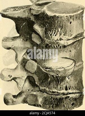 . über die Unterscheidung einer habituellen und constitutionellen form derselben : eine kritische und klinische Studie . in. Die concavseitigen-wurzel und der entsprechendeProcessus transversus erschei-nen in ihrem Diverrigungs-punkte im Vergleich zu denanderseitigen entsprechendenWirbelcomponenten meistensverändert und zwar etwasmehr frontalwärts abgewichen während, Bogenwurunder-sexer transzel versus wärts normale. Betreffs dieser Verhält-nisse bestehen nun graduell ausserorde Foto Stock