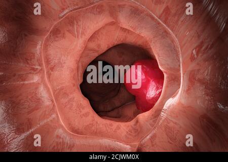 Illustrazione 3D del colon durante un'enteroscopia con un tumore intestinale o intestinale visibile. Foto Stock