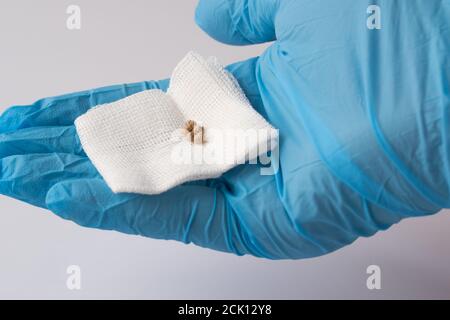 La mano del medico in un guanto blu tiene il taglio fuori kami dalla cistifellea Foto Stock