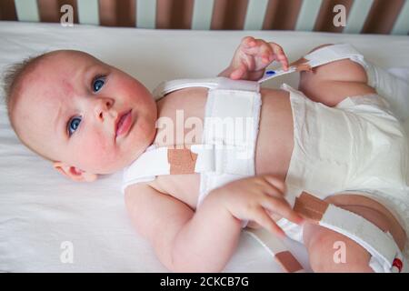 bambino di 4 mesi con displasia dell'anca in trattamento con Un cablaggio Pavlik Foto Stock