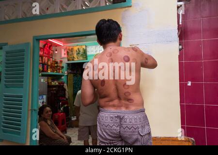 Ho Chi Minh / Vietnam - 25 gennaio 2020: Unriconoscibile uomo vietnamita pittura muro con muro pieno di lividi per il trattamento di medicina tradizionale Foto Stock