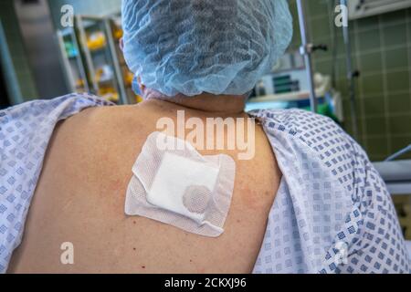 un paziente ha un grande ascesso sulla sua schiena Foto Stock