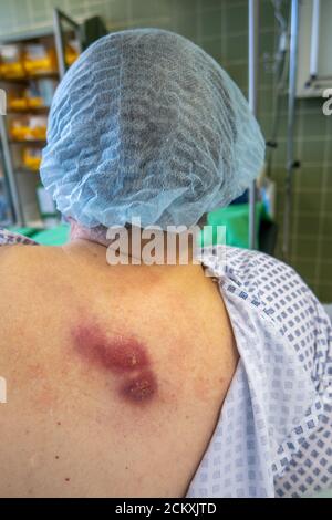 un paziente ha un grande ascesso sulla sua schiena Foto Stock
