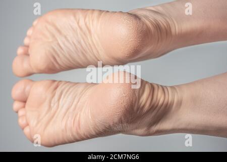 Suole di piedi asciutte e fessurate su sfondo bianco. Tacchi femminili Foto Stock