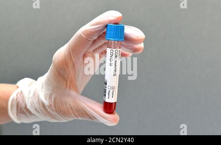 Provetta con risultato positivo del campione di sangue di analisi del coronavirus. Primo piano. Foto Stock