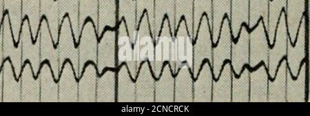 . La rivista tecnica Bell System . , con un circuito compandiero completo che utilizza il circuito di compressione No. 1, è stato trovato su accurati test di laboratorio con esperti che era quasi impossibile distinguere se il dispositivo 328 BELL SYSTEM TECHNICAL JOURNAL fosse in o fuori circuito. Inoltre, una distorsione di questo tipo viene generalesevenetata quando si utilizza il circuito compressore n°2. In tal caso si noterà che, se i due terminali sono collegati da un sistema di trasmissione sostanzialmente privo di distorsioni, gli identici circuiti di controllo dei due dispositivi ricevono una tensione di funzionamento identica Foto Stock