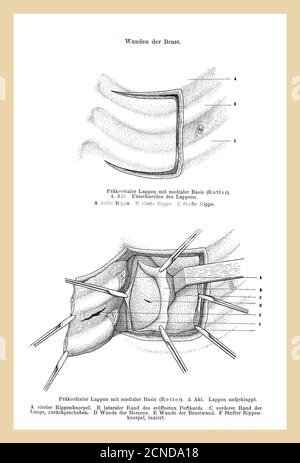 Sanità, medicina e chirurgia: Taglio precordiale del lobo, esposizione delle cartilagini delle costole con pericardio aperto e bordo polmonare, illustrazione vintage con descrizioni tedesche Foto Stock