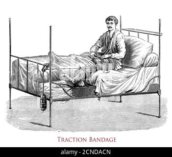 Sanità e medicina: Disegno che spiega come eseguire un bendaggio di trazione per la gamba rotta, illustrazione vintage Foto Stock