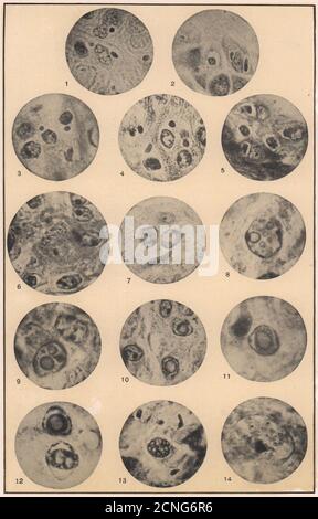 Piccolo pox. Medicina 1904 vecchio vintage stampa foto Foto Stock