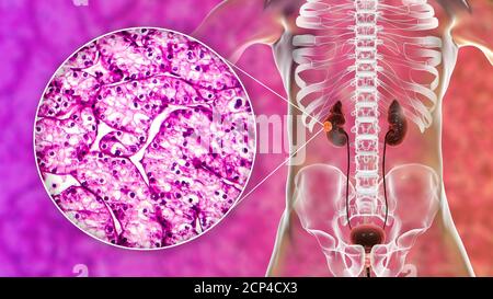 Cancro del rene, illustrazione del calcolatore e micrografia leggera. Foto Stock