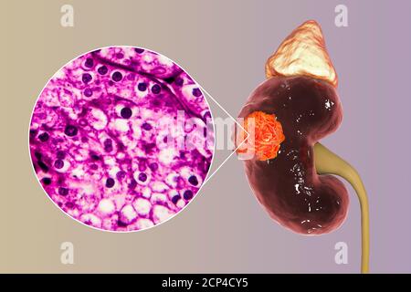 Cancro del rene, illustrazione del calcolatore e micrografia leggera. Foto Stock