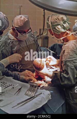 I medici di eseguire un taglio cesareo di un bambino New-Born in unione Hospital di New Ulm, Minnesota... ca. 1975 Foto Stock