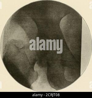 . un atlante radiografico dei cambiamenti patologici delle ossa e delle articolazioni . PIASTRA LXII. 172^ PIASTRA LXIII. FRACTUKE DEL COLLO ANOTOMICO DEL FEMORE - DIACNOSISWAS CLINICA CONTUSIONE DELL'ANCA. Il trocantere maggiore si trova in una posizione più alta del normale. La testa è in acelabuhim. La frattura passa attraverso il collo del femore. PIASTRA LXIII. 174 - PIASTRA LXIV. FRJCTURE DELLE OSSA PELVICHE: LA LINEA DI FRATTURA ATTRAVERSA THEACETABULUM. Foto Stock