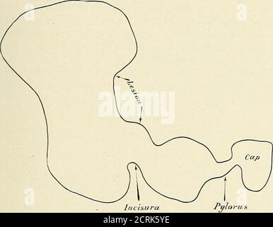 . Roentgen interpretation; un manuale per studenti e professionisti . FiO. 14.3.-grande ulcera della sella che causa lo stomaco di clessidra. STOMACO w:. Incjsura Fig. 144.-cancro alto sulla curvatura minore. Notare l'ampia area interessata e l'assenza di una proiezione definita. Foto Stock