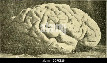 . Klinische und Anatomische Untersuchungen über den Cretinismus. Und Centralfurche, abgesehen von der früher erwähnten Veränderungdes Fusses der vorderen Centralwindung, von gewöhnlicher Beschaffenheit. Die hintereCentralwindung gegen den Scheitellappen durch eine nahezu die Länge der Central-furche erreichende einheitliche Postcentralfurche gegen den Scheitellappen abgegrenzt.Die Interparietalfurche entspringt selbstständig hinter der Postcentralfurche, bildet einretinden Schulisen über Unternen. 24 370 Patologische Anatomie. steil nach oben gerichteten Halbbogen, dessen hint Foto Stock