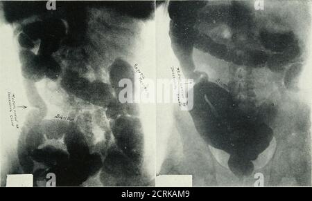 . Archivi di medicina fisica e riabilitazione . Tig. 23 e Fig. 24 sono matei che indica la posizione dell'intestino crasso. La posizione della sigmoide, delle flessure e dei due punti ascendenti e trasversali è insolita. Appendectomia ha dato sollievo dai sintomi. Maiale. 25.-ridondanza del grande bowel. In particolare sigmoid.la testa freccia indica frequenti sedi di riduplica; in alcuni casi si verificano occasionalmente sintomi ostruttivi. Maiale. 26.-Bedund.incy di Bigmold con spasmo di ricuplicazione del colon discendente a livello della cresta iliaca. Non è stata istituita alcuna interferenza chirurgica. Il colonicdist acuto Foto Stock
