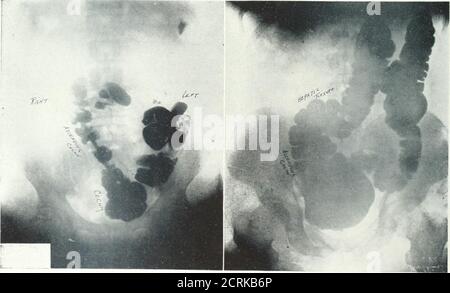 . Archivi di medicina fisica e riabilitazione . p;. A o «o 2 a K isti ^■s p. 3i5s5. RIG. 21.-ThiB rivela la posizione del pasto opaco sei ore dopo l'inestimazione Sliows cecum e ascenclintr colon vicino alla linea mediana. Il diag-noBls Boentgenological di appendicitisè stato verificato chirurgicamente. Credenza è stata ottenuta. Vedere Tig. 22. 370 carro-. 22.-enema opaco. Questo sicuramente verificato previoesame. Vedere Fig. 21. ANOMALIE DI POSIZIONE DEL TRATTO INTESTINALE - HUBENY Foto Stock