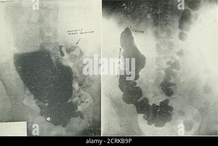 . Archivi di medicina fisica e riabilitazione . Fig. 17.-situazione elevata di ceco e flessione epatica.colon ascendente breve. DlagnoBls Boentgenological di ap-pendicite verificato. Il precedente dia^rao*!* era gall-bladderdliaai*. 368 ANOMALIE POSIZIONALI DEL TRATTO INTESTINALE - HUBEXY. Tig. 18.-questo e tlie twu ligurss iuiuiueia,ti.«glia-sono dello stesso paziente. La diag-uosi clinica è stata duodenalQlcer Roentgen esame dello stomaco e duodenumonia è stato richiesto, tuttavia, mediante sug-g-ingestione, è stato eseguito un esame completo-astro-intestinale, con un ul-timate diag-nobis dell'appendice i. Foto Stock