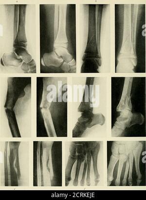 . Radiografia, radioterapia e radioterapia . PIASTRA XX. - fratture in corrispondenza dell'articolazione caviglia. a. Frattura obliqua attraverso l'estremità inferiore del fibula, (a) laterale, {b) viste antero-posteriori. b, frattura di malleoli interni ed esterni, spostamento del piede verso l'esterno all'articolazione della caviglia. c, frattura dell'astragalo. d, dislocazione della frattura all'articolazione della caviglia Frattura estremità inferiore fibula.. PLA.TE XXI. – frastoloni di gamba, caviglia e piede. «, frattura obliqua dell'albero della tibia, vista laterale, mostra le epifasi dell'estremità inferiore della tibia e anche di OS calcis. b, vista antero-posteriore della tibia e della fibula, mostrando un ob Foto Stock