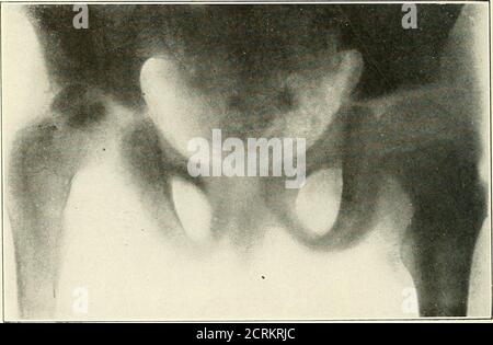 . Roentgen interpretation; un manuale per studenti e professionisti . Fig. 75.--tubercolosi dell'articolazione del ginocchio.. Fig. 7G.-tubercolosi dell'anca. Un caso iniziale. TUBERCOLOSI 103 Foto Stock