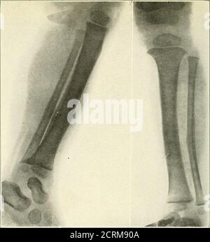 . Roentgen interpretation; un manuale per studenti e professionisti . Fig. 19.-frattura patologica dell'estremità superiore della tibia in caso di malattia di Pagets.. Fig. 20.^-Greeii-stick frattura del tibisB, con notevole forma callosa che suggerisce cambiamenti periostei. Foto Stock