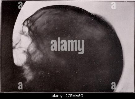 . Giornale di radiologia . Maiale. 6 metastasi ai linfonodi del affondo. Nota i molti minuti shot-likisbodies sparsi in tutti i tessuti polmonari. 84 THE JOURNAL OK RADIOLOGY. Fig. 7 agosto 23, 1919. Metastasi al cranio. Xote il nuovo deposito osseo inrays perpendicolare alla superficie del cranio, caratteristica di osteosarcoma. Alsonote le zone di rarefazione ossea in altre pr.rts del cranio. OSTEOSARCOMA - KNERR 85 Foto Stock