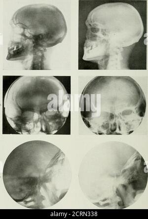 . Radiografia e radioterapeutica . &gt; &gt; a. ILATK XV.-NOR.mai, Skulls. A, vista laterale del cranio normale, sliowiig seni frontali, seni sphenoidal, sella turcica, ossa temporali, vertebra cervicale;, b, Vista antero-posteriore del cranio adulto, seni frontali scivolanti, orbite, fossa nasale, antra, ecc. Frontalsinus sul lato sinistro è opaijue. c, vista laterale del cranio per mostrare Tlie sella turcica, articolazione della spina dorsale al cranio; articolazione tcmporo-niaxillaryarthibition su un lato è ben visibile. RADIOGRAFIA DEI SENI ACCESSORI 209 Foto Stock