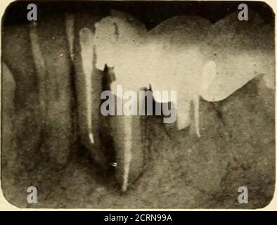 . Roentgoenology orale : uno studio Roentgen sull'anatomia e la patologia della cavità orale . Figura 264.. Foto Stock