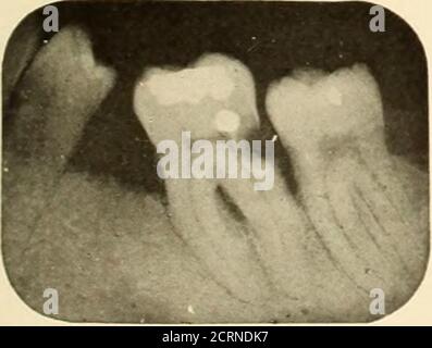 . Roentgoenology orale : uno studio Roentgen sull'anatomia e la patologia della cavità orale . Figura 86.. Foto Stock