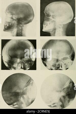 . Radiografia e radioterapeutica . O ca a &lt;. PIASTRA XV - cranio normale a, vista laterale del cranio normale, con seni frontali, seni spenoidei, sella turcica, ossa temporali, vertebre cervicali, b, Vista antero-posteriore del cranio adulto, che mostra seni frontali, orbite, fossa nasale, antra, ecc. il Frontalseno sul lato sinistro è opaco. c, vista laterale del cranio per mostrare la sella turcica, articolazione della colonna vertebrale al cranio; l'articolazione temporale-maxillarysu un lato è ben visibile. RADIOGRAFIA DEI SENI ACCESSORI 209 Foto Stock