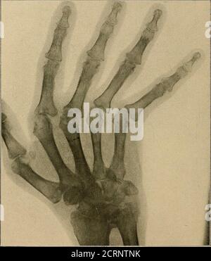 . Un testo-libro di radiologia . Fig. 56. Frattura delle colate. Frattura dello scafoide. Spesso è molto difficile ottenere una buona radiografia di questo giunto: A parte il leggero movimento, i bonescomponendolo sono per lo più spugnosi e privi di densità che conferisce tale carattere ad una radiografia di ancaviglia, ad esempio. Scapola. – UN tubo morbido e una breve esposizione arenecessary per il successo qui. Il raggio normale si dirigerà verso l'interno tra l'omero e il TESTO-LIBRO toracico 144 DI RADIOLOGIA. Muro. Il risultato è un notevole scorcio di theshadow, ma questa visione è buona da mostrare fratta Foto Stock