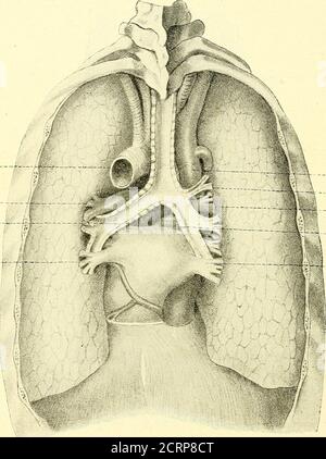 . Grundriss der Lungenchirurgie . JV.phrenicus Fig. 8. Brustfellkuppeln. [Nach einem Präparat des Königsberger anatomischen Instituts. Jede Lunge Hat die Gestalt eines der Länge nach halbiertenKegels, d. h. eines Halbkegels. Man kann unterscheiden:die Spitze, Apex, eine leicht konkave Grundfläche, die basis,eine mediale, leicht konkave Fläche,eine laterale konvexe Fläche.Die Spitze ist nach der Brustapertur hin gerichtet, die basis (Faciesdiaframmatica) ruht auf dem Zwerchfell. Die laterale Fläche (facies 16 c. Garre. Costalis) liegt dem Brustkorb resp. Den Rippen, die mediale Fläche(facies m Foto Stock