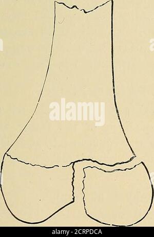 . I raggi Röntgen nel lavoro medico . Fig. 114.-separazione pura e completa. Fig. 115.-separazione parziale, con frattura della diafisia.. Foto Stock