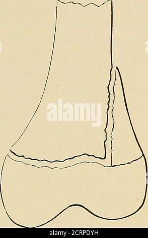 . I raggi Röntgen nel lavoro medico . Fig. 114.-separazione pura e completa. Fig. 115.-separazione parziale, con frattura della diafisia. Foto Stock