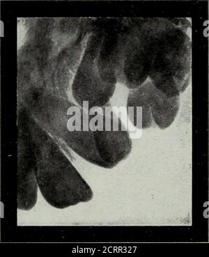 . Radiografia elementare e dentale . Fig. 296 Fig. 297 Fig. 296. Malposed impattò la bassa cuspide, responsabile delle emicranie periodiche. (Radiografia di Thomas, di Cleveland.) Fig. 297, una cuspide superiore impattata, che ha causato il lampeggiamento degli occhi. (Dopo il dottor Varney Barnes). TIG* 297- 59* Tn gas della gotica gesticolatrice facciale. (Twitcbind spasmodico di una serie di muscoli Tadali). Una cuspide superiore impattato che ha causato il lampeggiamento degli occhi.**Dr. Barnes ha anche riportato un caso di contrazioni dei muscoli facciali su un lato. Sul lato corrispondente sono stati trovati due denti supernumerari. Non sono stato in grado di imparare Foto Stock