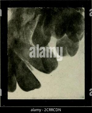 . Radiografia elementare e dentale . Fig. 29 G Fig. 297 Fig. 296. Malposed impattò la bassa cuspide, responsabile delle emicranie periodiche. (Radiografia di Thomas, di Cleveland.) Fig. 297. Una cuspide superiore impattata, che ha causato il lampeggiamento degli occhi. (Dopo il dottor Varney Barnes). Tig. 297. 59. TN casi di gesticolazione facciale. (Contrazioni spasmodiche di una serie di muscoli tattici). Una cuspide superiore impattato che ha causato il lampeggiamento degli occhi.**Dr. Barnes ha anche riportato un caso di contrazioni dei muscoli facciali su un lato. Sul lato corrispondente sono stati trovati due denti supernumerari. Non sono stato in grado di imparare Foto Stock