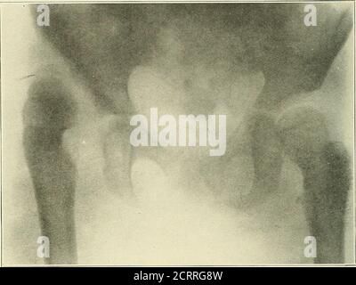 . Elettroterapeutica pratica e radioterapia : con capitoli su fototerapia, radiografia in chirurgia oculare, radiografia in odontoiatria e aspetto medico-legale dei raggi X. Fig. 171.-frattura dell'acetabolo, con spostamento di una porzione della parete posteriore. Spesso è necessario effettuare due o tre esposizioni con angolature diverse prima che la condizione esatta possa essere resa chiara. Fig. 171 è uno skiagraph che mostra una dislocazione del femore UP-346 PRATICO ELETTROTERAPEUTICO E terapia a RAGGI X avanti e indietro, con frattura della parete posteriore del ACE-tabulum. I frammenti dall'acetabolo sono in Foto Stock