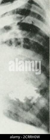 . Archivi di medicina fisica e riabilitazione . Tig. 11-ascesso di iung dovuto alla proiezione diretta di materiale alimentare infetto negli tlsssui interstiziali del polmone, a seguito della distruzione del wallderoma esofageo, a) che mostra la distruzione della parete esofagea da carci-noma, (b) che mostra la grande area di consolidamento nel polmone con la cavità fllllllled del largebarium nel suo mezzo. Il polmone inferiore destro. Nessun tipo particolare di coinvolgimento ha mostrato alcuna predisposizione spe-ciale alla cura spontanea. Clinicamente, un paziente può apparire co-pletely cured, mentre radiografico ex-am Foto Stock