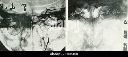 . Archivi di medicina fisica e riabilitazione . Tig. 1 - Spiegenoida di diverse densità. Tig. 2-un lato dello sfenoide riempito di piombo.i^ead riner intorno al foramen magnuni.. Tig. 3-sfenoide sinistro riempito di piombo. Fig. 4 – spenoidi destre e destre. 65 caso insolito di CalcifyingFasciite essudativa con estesi depositi CalcareousIntermuscolari. HarryLowenburg, M. D., PennsylvaniaM. J., 26:21. Ottobre, 1922.T^IL suo raro caso è descritto in detailand illustrato da accompagninradiografie. Apparentemente è unico, dal momento che una lista di imposmg di consulenti aresummenzionato, nessuno dei quali aveva mai en-counte Foto Stock