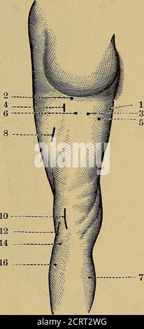 . Un trattato pratico sulla diagnosi medica per studenti e medici . Punti motore della coscia, superficie anteriore. Punti motore della coscia, superficie posteriore.(da von Ziemssen.) Fig. 56.-1. Tensor vaginae femoris (ramo del nervo gluteo superiore). 2. Nervo cruralanteriore. 3. Tensor vaginae femoris (ramo del nervo crurale). 4. Nervo otturatore. 5. Rectusfemoris. 6. Sartorius. 7. Vastus externi. 8. Adduttore longus. 9. Vastus externi. 10. Branchof il nervo crurale al quadricipite estensore cruris. 12. Crureus. 14. Ramo del nerveto crurale il vastus externi. Fig. 57.-1. Aggiungi Foto Stock