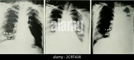 . Archivi di medicina fisica e di riabilitazione. Alcune settimane coinvolgono praticamente l'entirelung. Il quadro dei rentgen non è unlikthat a volte vediamo in influenzalpolmonite. In altri casi i pleuralchange sembrano predominare. Questi sono dovuti a neoplasie metastatiche, sembrano perseguire un decorso completamente diverso da quello osservato in casi non trattati. Abbiamo casi in cui lo studio motcritical non riesce a mostrare alcuna pathology nel trattamento antedating del torace. Non è irragionevole credere che il cambiamento thatsome accadrebbe nel lungas un risultato del trattamento intensivo del rentgen. Voi ma Foto Stock