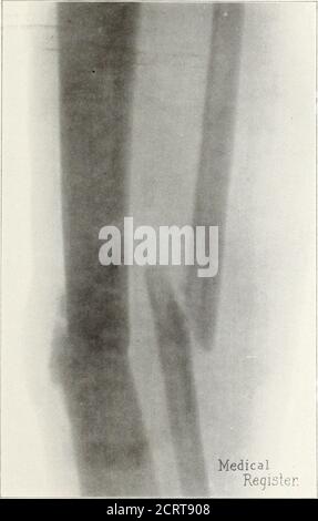 . Rivista americana di radiologia . Piastra III. Caso II. Frattura della tibia destra e della fibula. Vista antero-posteriore. Il filo d'argento è stato usato per tenere le ossa in ha avuto un notevole dolore durante le prime due posizioni. Ferita chiusa con giorni di gut-gatto causati dallo stiramento delle suture; nessun drenaggio. Muscolatura antisettica; è stato alleviato da un moderato ing applicato e l'arto messo in su in un gesso- dosi di morfina. Intonaco di parigi spica che si estende dal piede al rimosso alla fine di sei settimane : primario 77//C AMERICAX RAY JOCN.XAL. 519 unione perfetta ; osso saldamente unito. Il giorno seguente il paziente era tutto Foto Stock