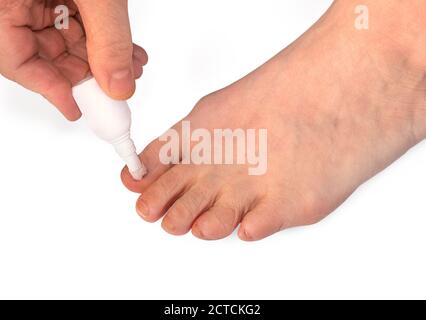 Applicazione di trattamento / medicina per infezione fungo toenail. Primo piano parziale del piede. Tutte le unghie dei piedi sono scolorite, leggermente sagomate, deformate e incrinate. Foto Stock