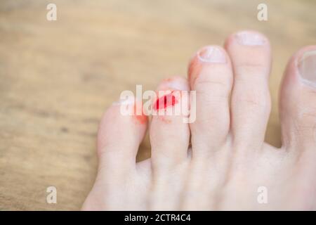 sangue sulla punta del piede di un uomo primo piano. concetto di salute e igiene Foto Stock