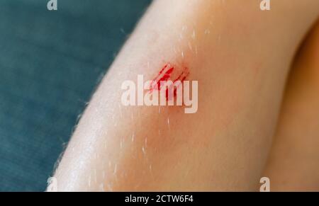 Rigatura fresca con sangue sulla gamba di un bambino. Primo piano Foto Stock