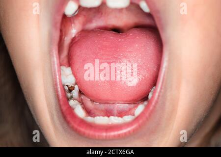 la giovane ragazza urla da un mal di denti. Problemi dentali nei bambini. Carie precoci e denti decadenti. Il concetto di cura della cavità orale. Foto Stock