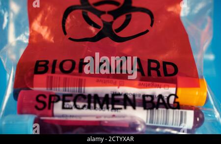 Covid pazienti campioni di sangue in un sacchetto di rifiuti medici. Pericolo medico Foto Stock