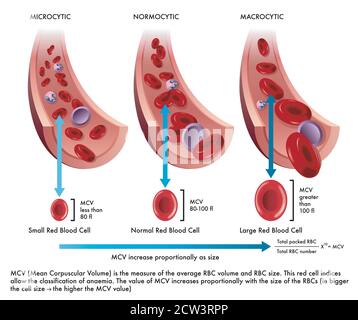 l'illustrazione mostra la differenza tra un normale eritrocita con uno affetto da microcitosi e un altro da macrocitosi, con annotazioni Illustrazione Vettoriale