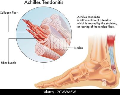 Una illustrazione medica dei sintomi di Achille tendinite o infiammazione del tendine di Achille. Illustrazione Vettoriale